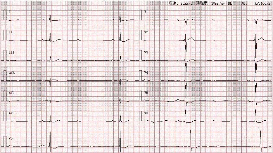 心电图图库丨二度ii型21房室传导阻滞系列