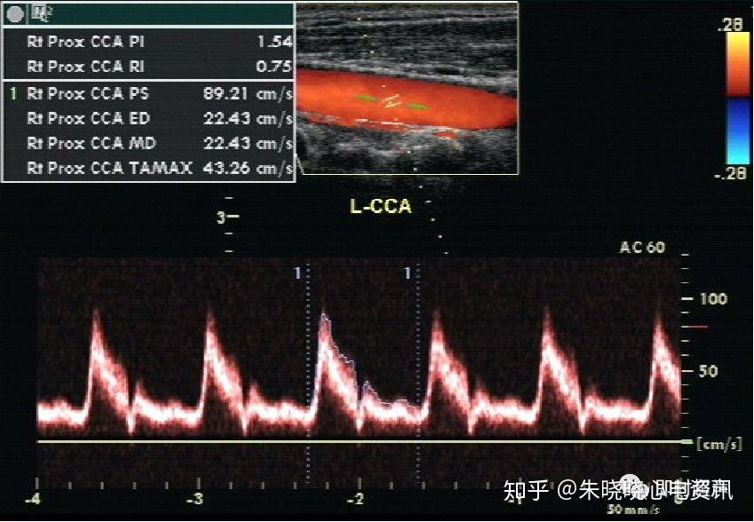 患者取平臥位,頸後墊枕,頭後仰暴露頸部,選用7mhz～10mhz線陣探頭.