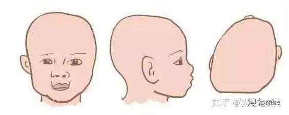斜头:一侧后脑勺平坦,头颅不对称,前额突出,从头顶看像平行四边形