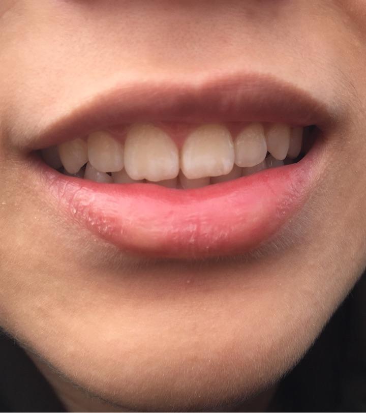 牙齿上长了白色的东西