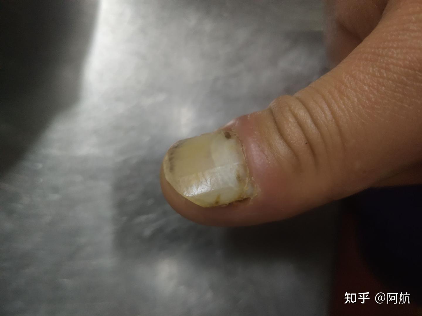 手指被车门夹伤痊愈全过程(血和泪的教训) - 知乎