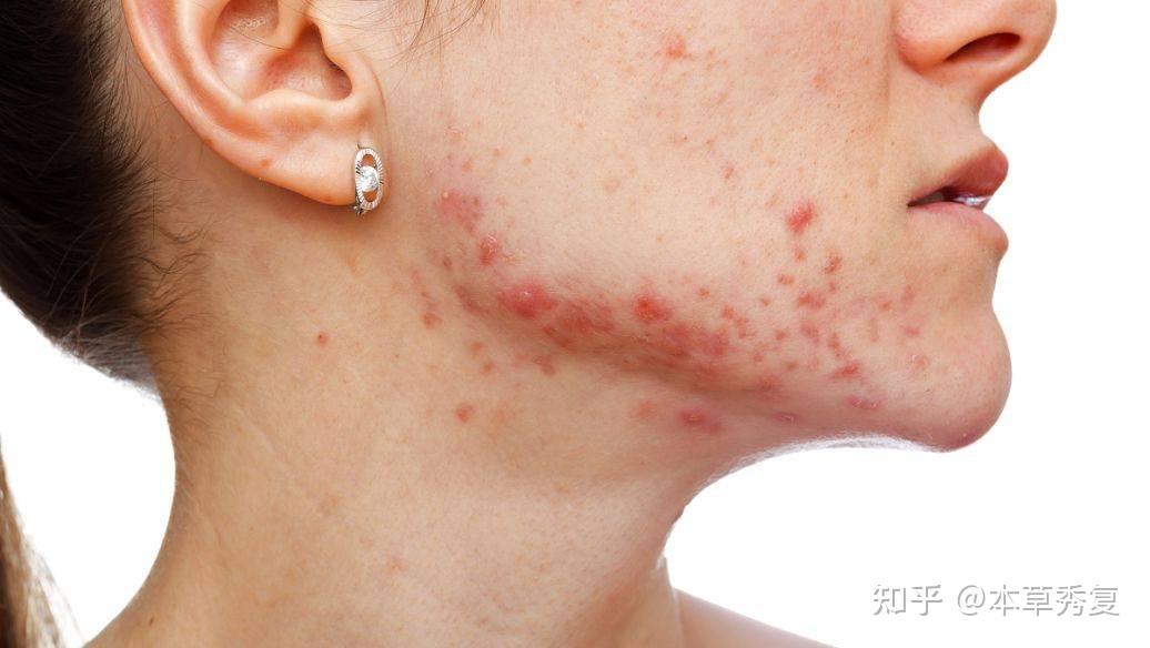 有没有办法可以天天熬夜皮肤还很好