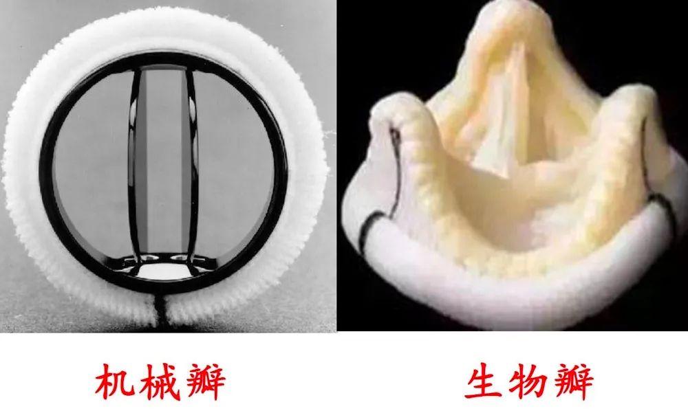 主动脉瓣机械瓣图片