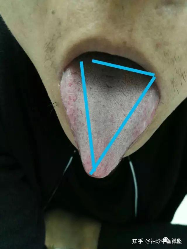 前面7篇系列文中多次提到这种"三角舌",舌型如三角,据我长时间的观察