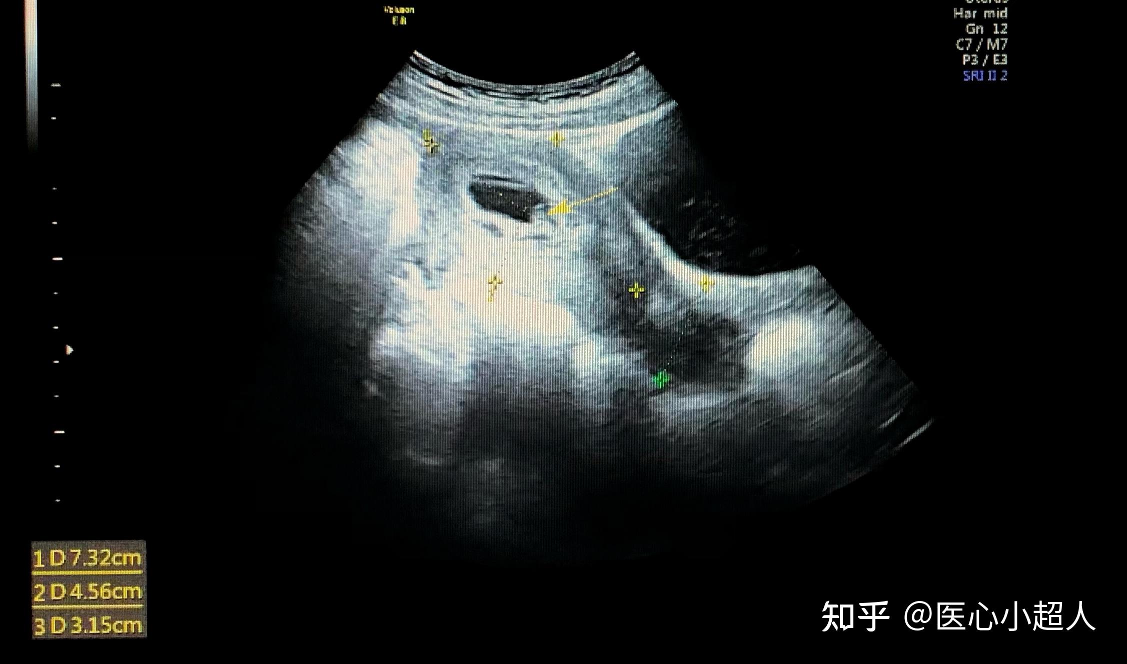怀孕10周胎儿彩超图片,孕10周宝宝b超图片 - 伤感说说吧
