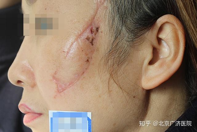 疤痕颜色接近肤色,表面光亮,凹陷边缘较软,呈钝角,牵拉后疤痕容易平复