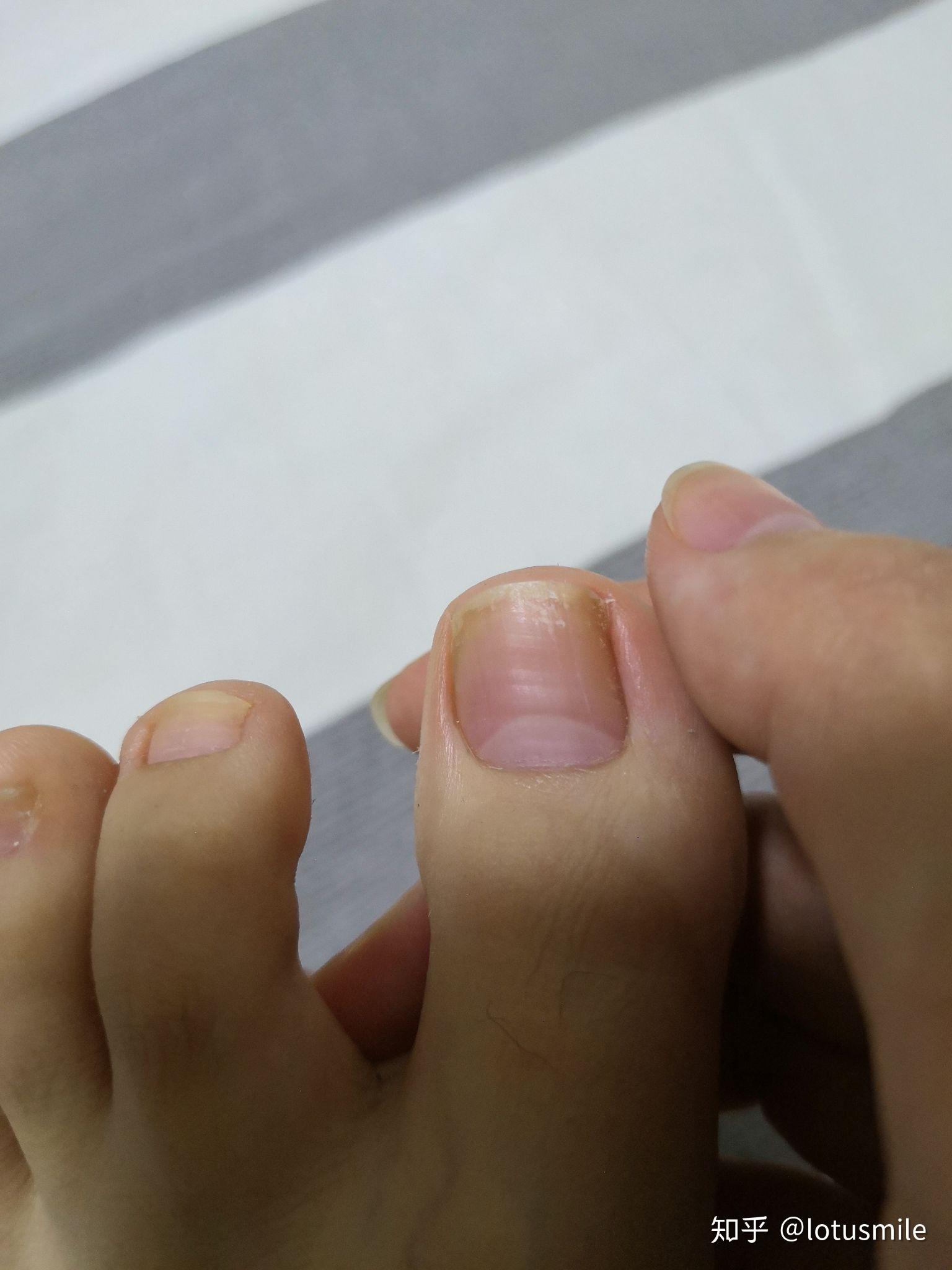 灰指甲初期症状有哪些？很难治吗？ - 哔哩哔哩