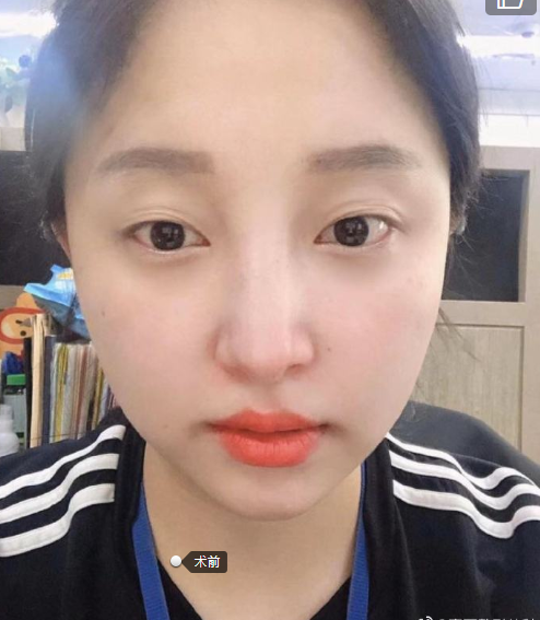 凸嘴怎么整成平嘴 v2-8745e9943d38287909e88da76b883109_1440w.jpg?source=172ae18b