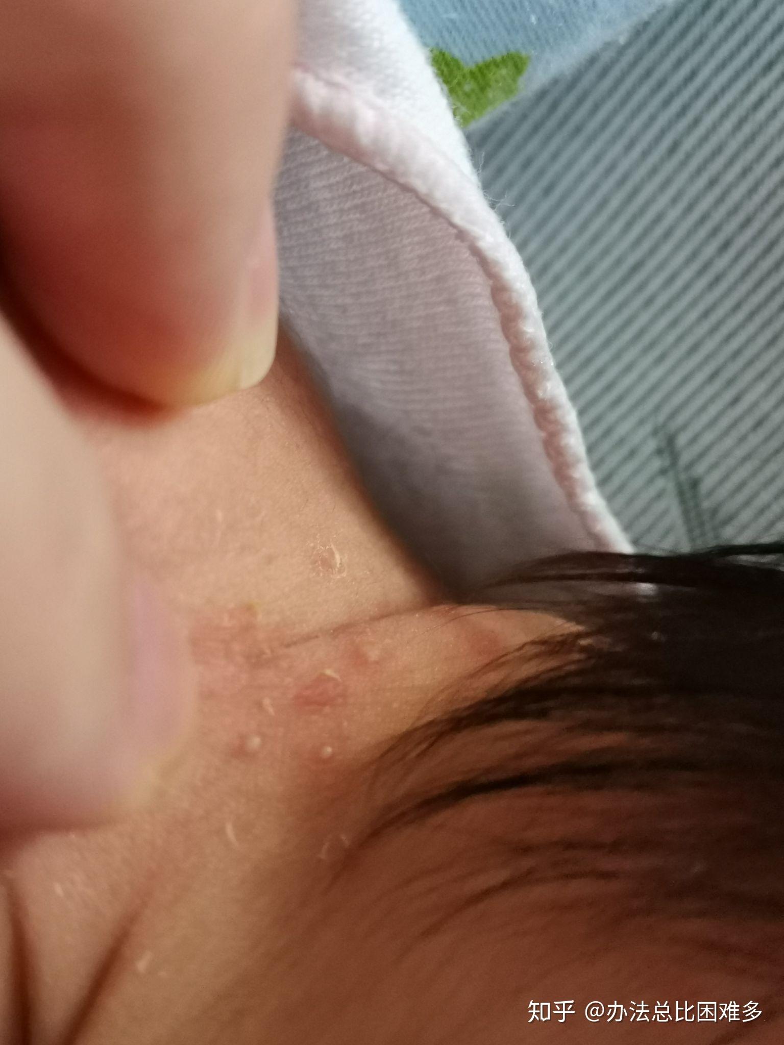 宝宝湿疹感染化脓图片图片