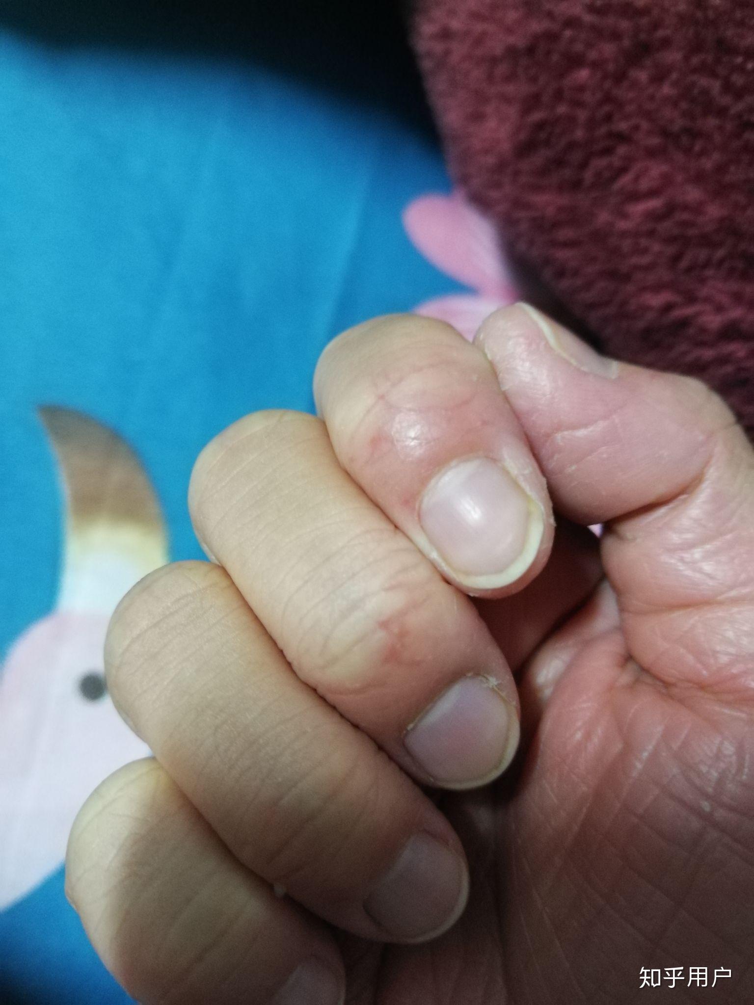 先天性就有掌跖角化症 而且很严重 有心理障碍? - 知乎