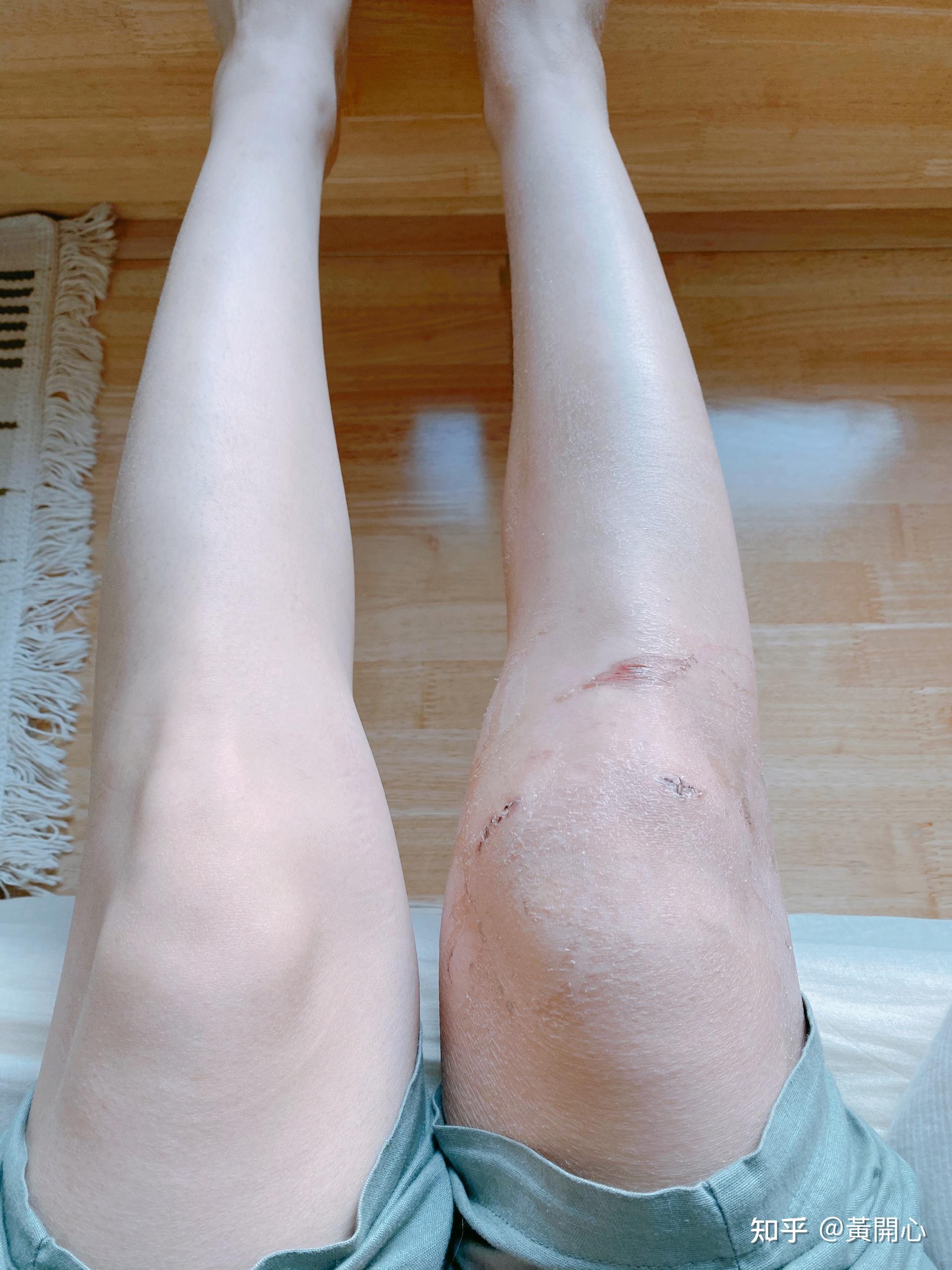 半月板撕裂囊肿,关节镜修复手术分享