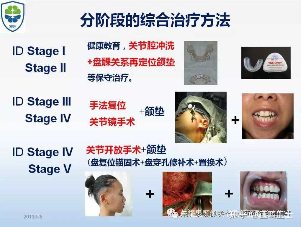 颞下颌关节盘移位的分期治疗本文转载自朱耀旻颞颌关节及颌面整形工作