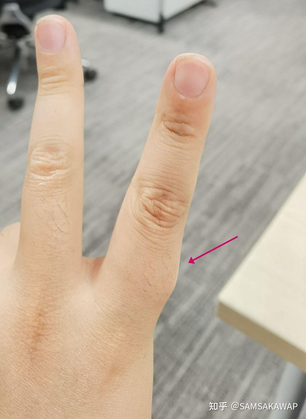 分享切除腱鞘纤维瘤的经历