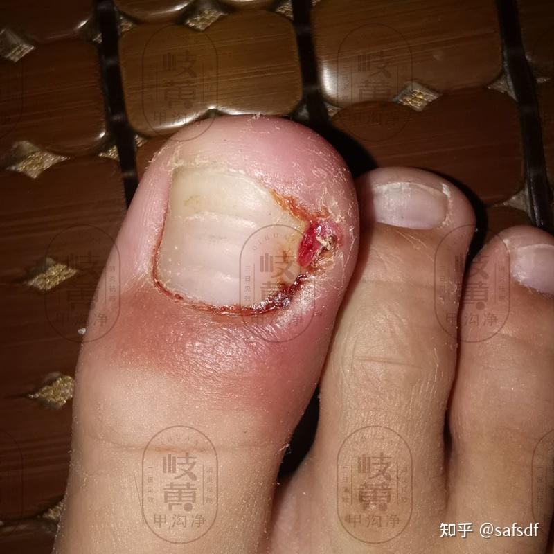 甲沟炎化脓 知乎