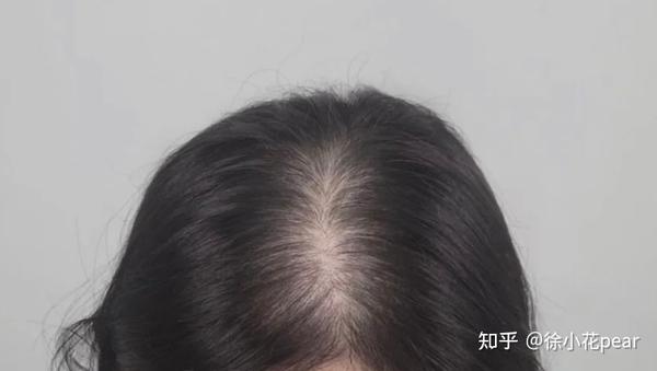 手指轻轻一捋,就能掉好几根头发,严重影响自己生活了,有没有人知道防脱方法? - 知乎