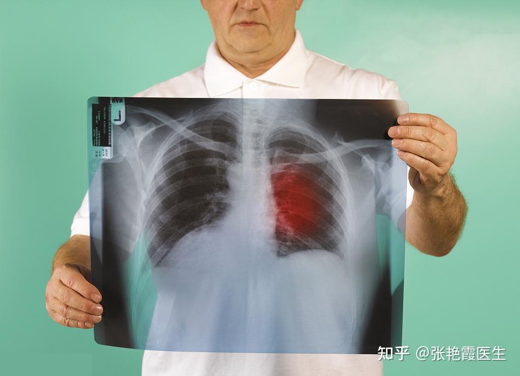 烟龄60年的肺图片图片