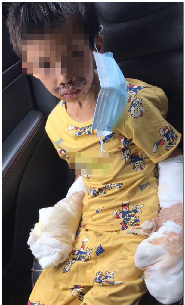 抚顺亲妈虐童案后,又曝广东男童被父亲烫伤严重至截肢!