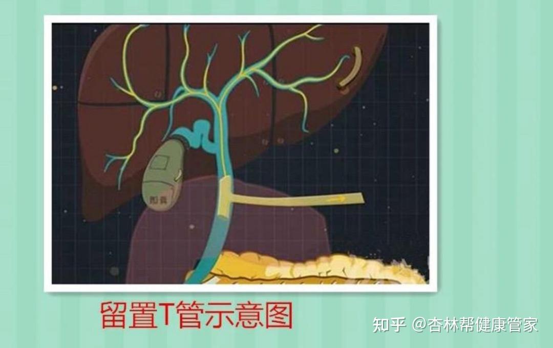 胆道镜及取石的科普 - 知乎