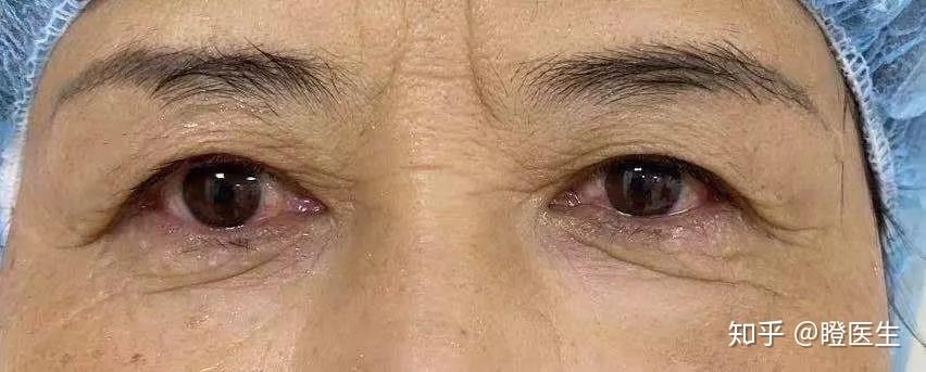 眼皮松弛是切眉好还是做双眼皮好