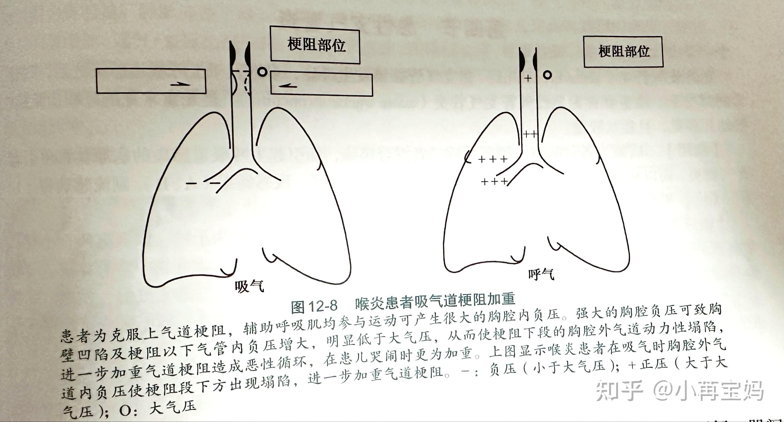 空、空、空犬吠样咳嗽，小心儿童的急性喉炎！ - 知乎
