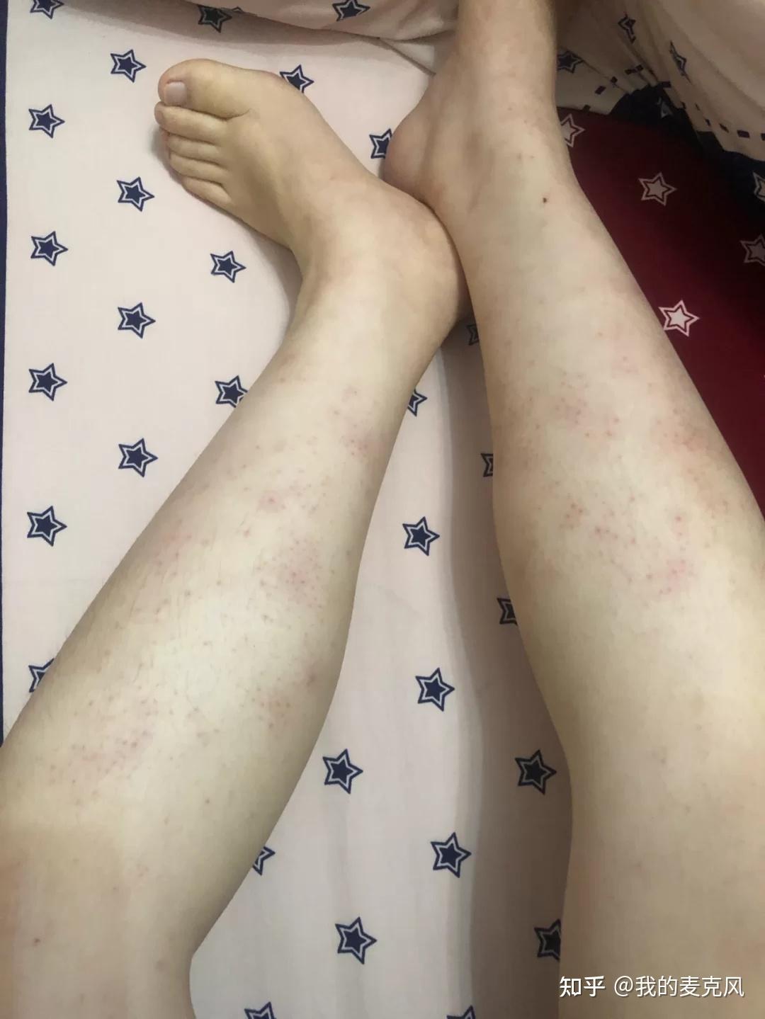 湿疹会传染吗? - 知乎