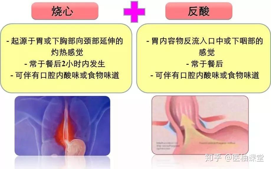 胃食管反流病怎么治，看这篇就够了！ - 知乎