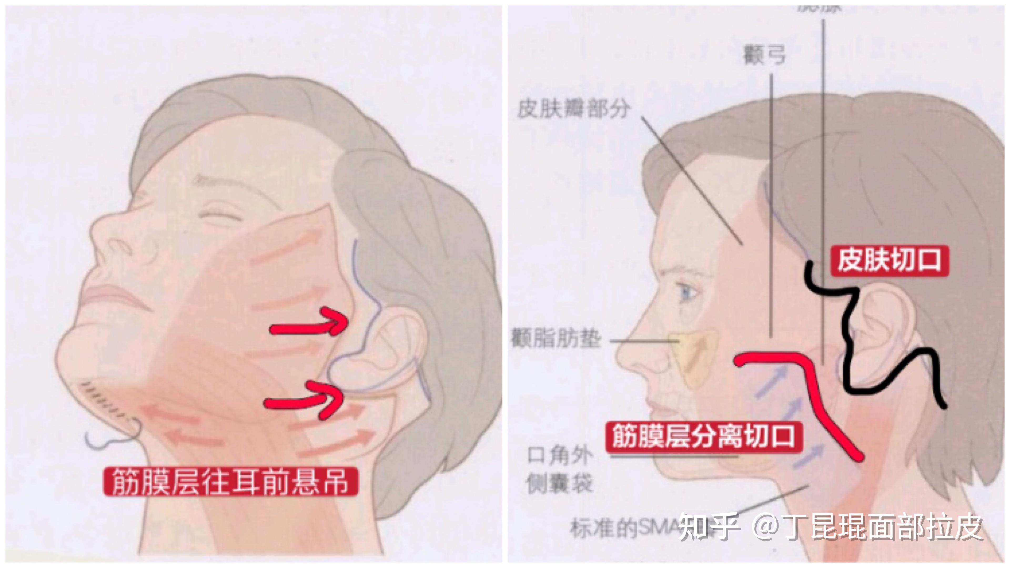 面部拉皮手術不講審美問題很大