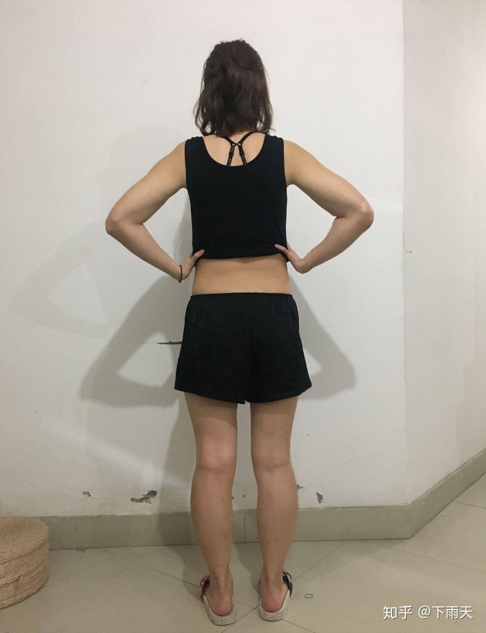 腰腹吸脂三月了我再也不是小粗腰了