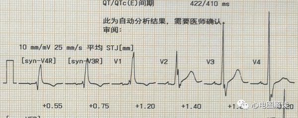 完全性右束支阻滯在12導聯及右胸導聯的表現,右心室大?