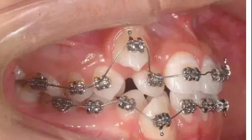 牙齿矫正过程中会很疼吗很难受吗