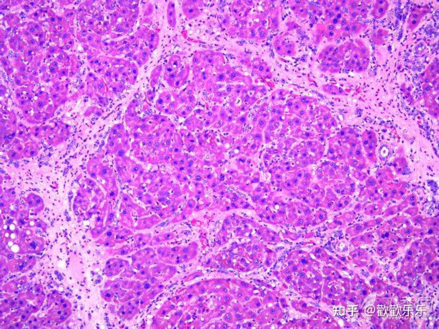 肝硬化1                   肝硬化2模型成功后,肝脏的病理