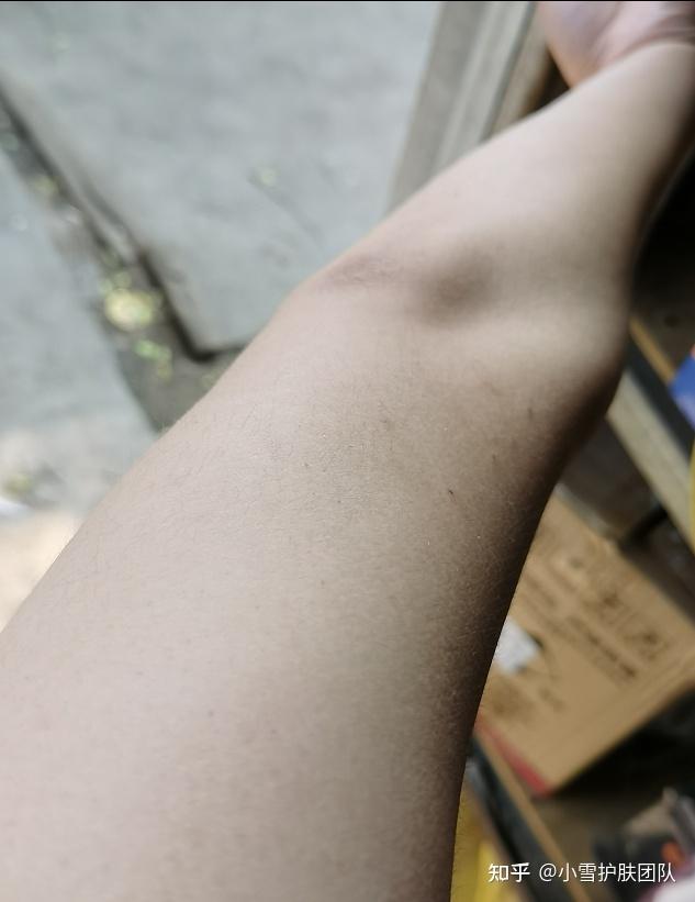 睡觉时皮肤起鸡皮疙瘩(睡觉晚上老是身上起鸡皮疙瘩)