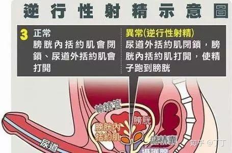 高潮过后没有精子?你的精子可能逆流而上了 - 知乎