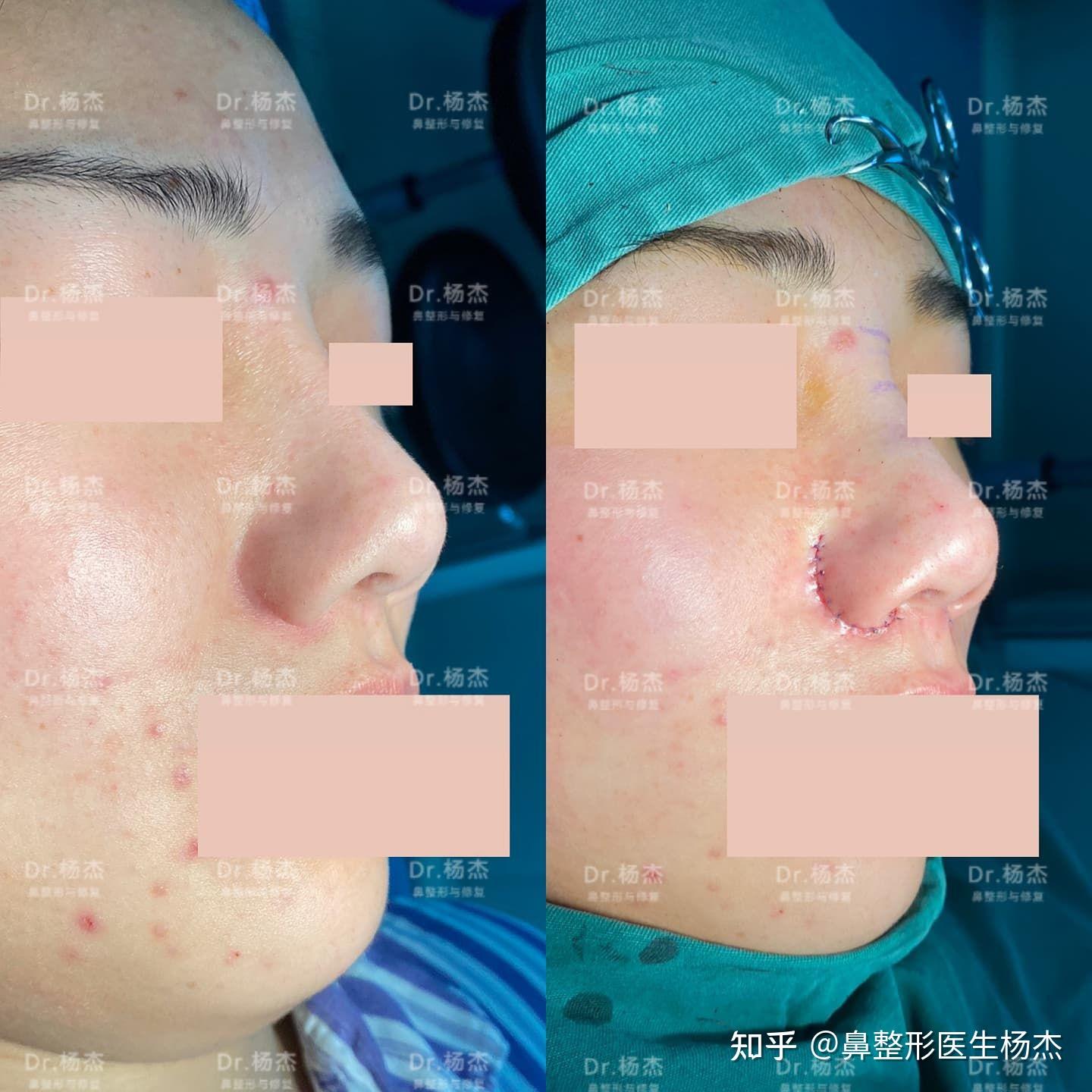 鼻翼疤痕修复案例-杨杰-爱问医生