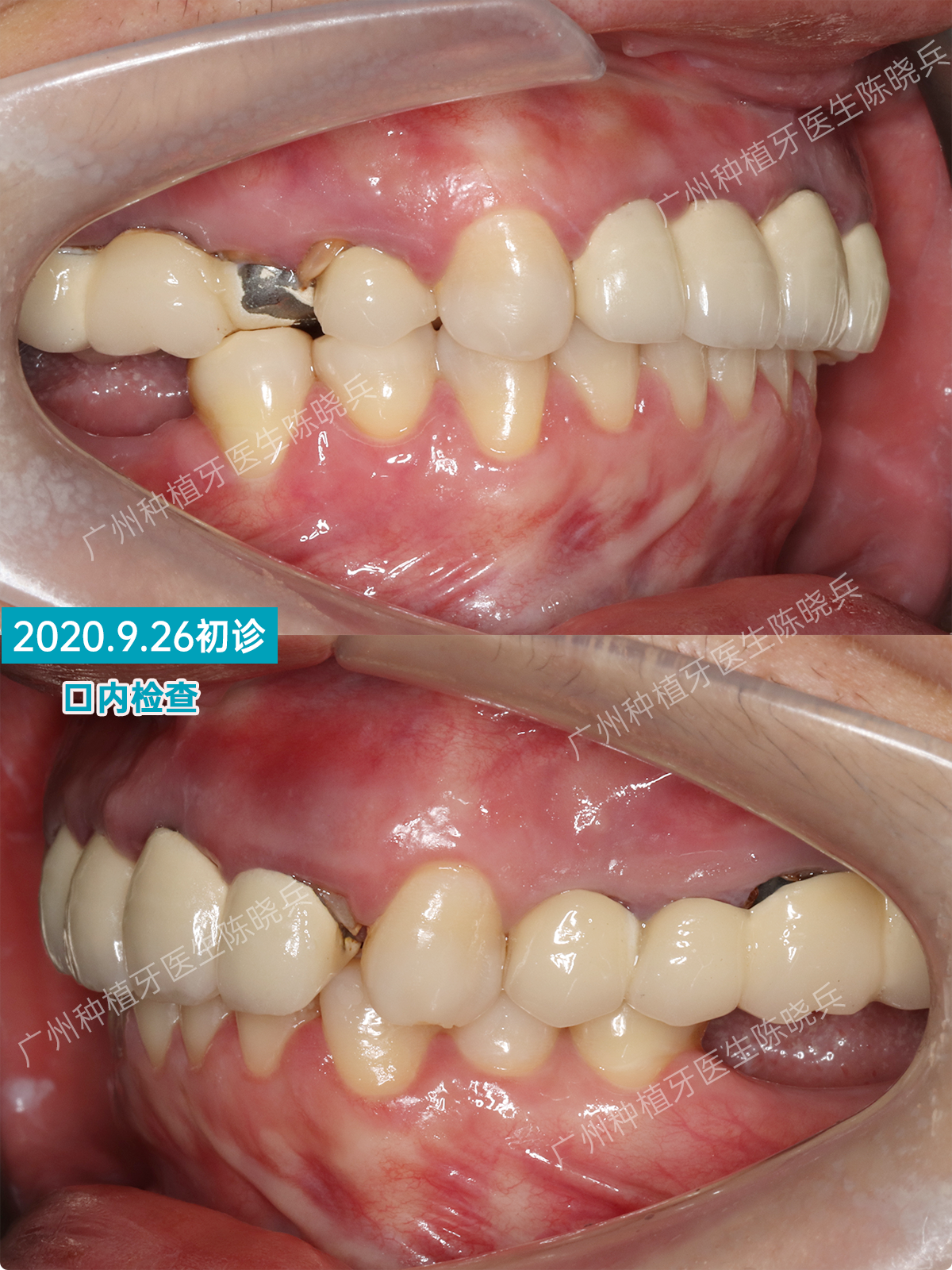 目前已经进行到三期取模,两周后就可以戴冠,后续再处理其他牙齿