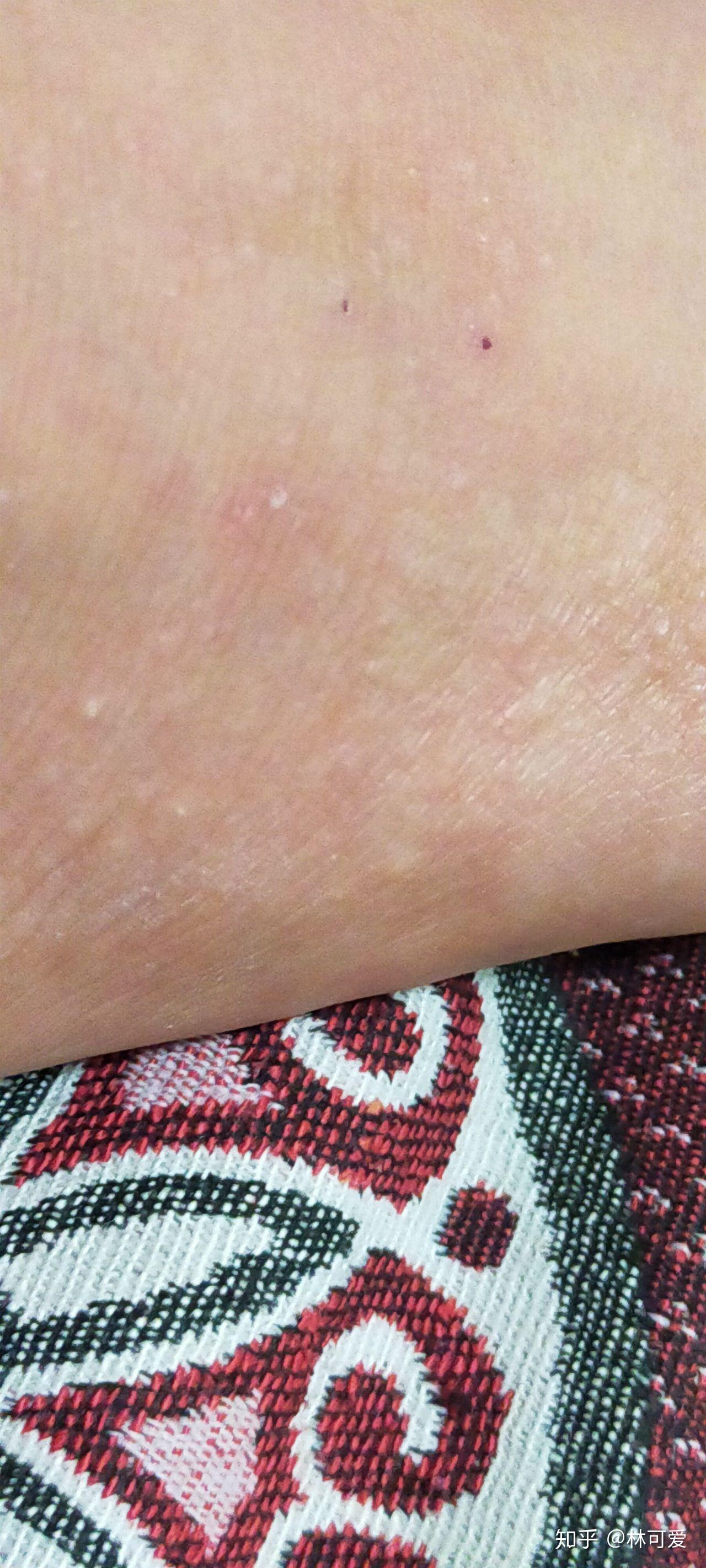 脚上突然出现很小的疙瘩有点痒怎么回事
