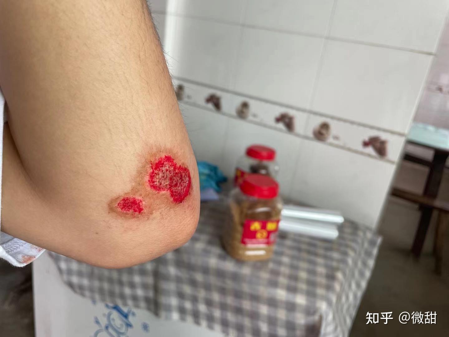 膝盖摔伤痛苦的回忆大佬们该怎么上药啊