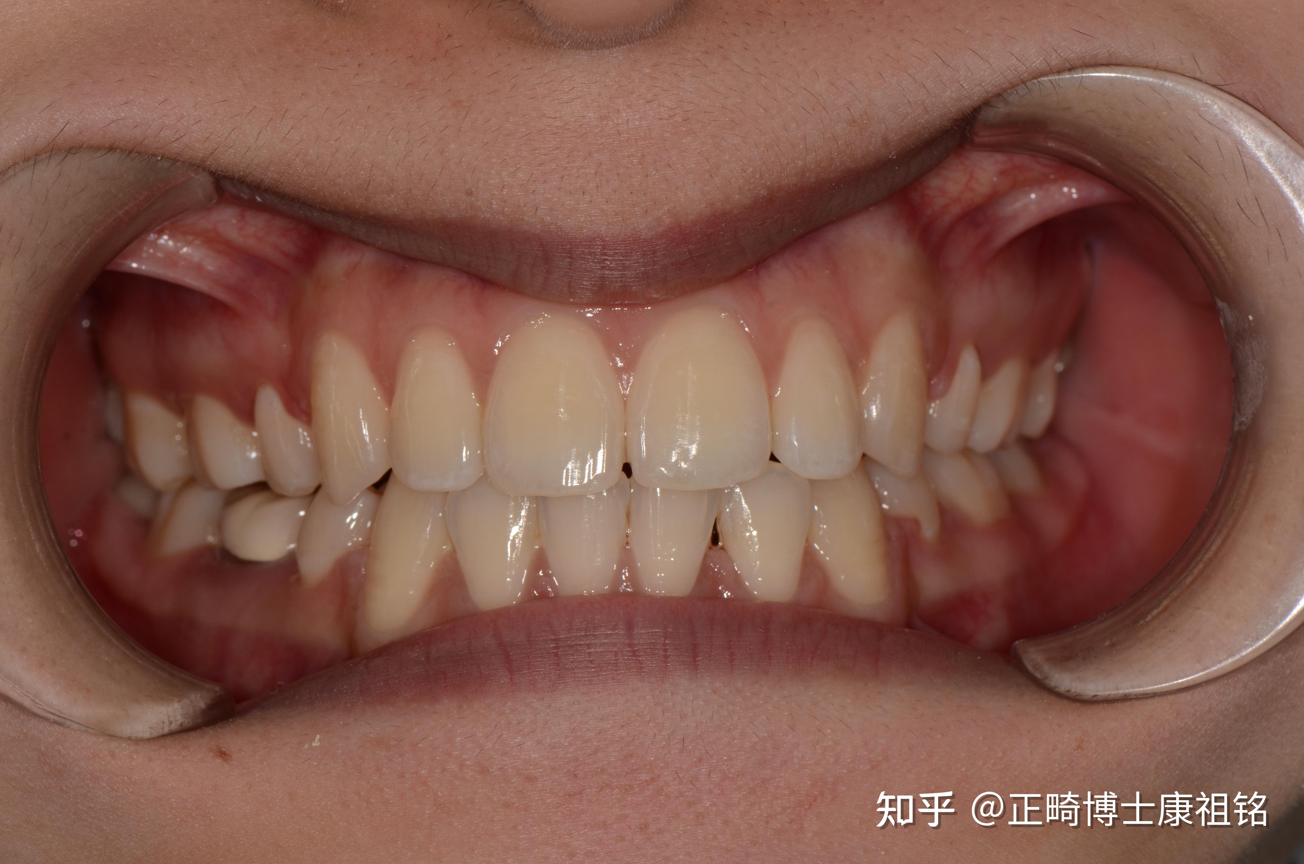 不拔牙隐形矫正，12个月解决牙列拥挤！—义乌牙齿矫正 - 知乎