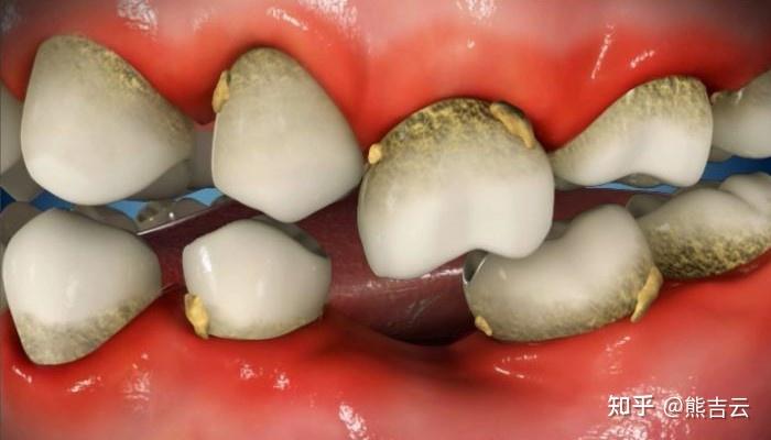 吃饭时总塞牙问题出在那里