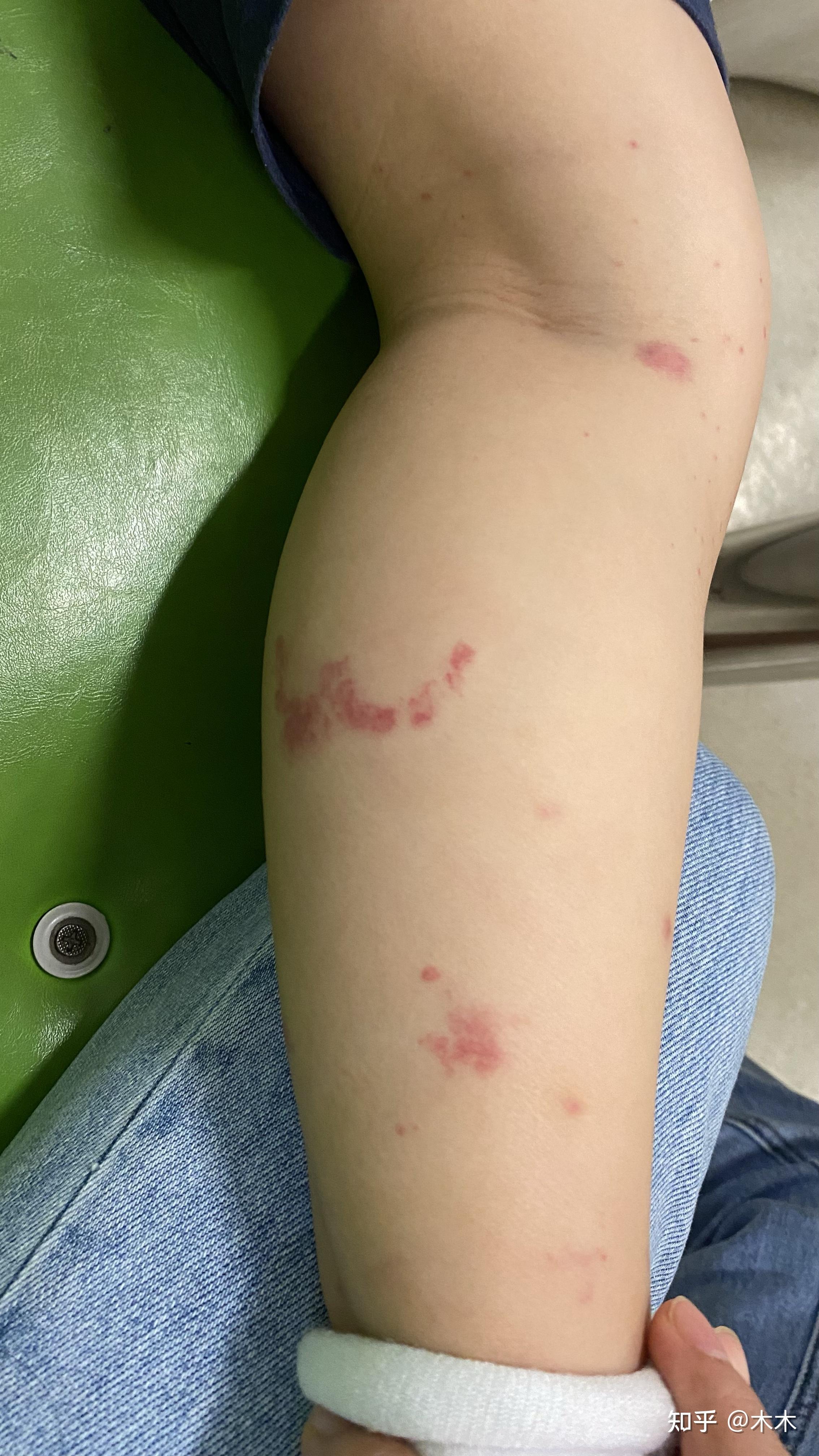 记录6岁孩子过敏性紫癜治疗过程