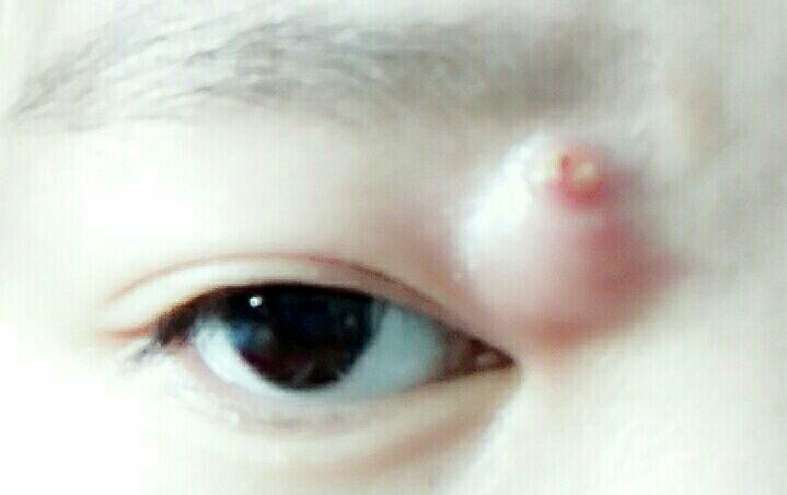 眼睛旁边切除皮脂腺囊肿,对视力及面部的影响? - 知乎