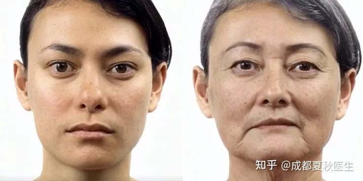 液态骨雕童颜术——重塑年轻轮廓针对骨相不足,骨容积缺失的情况,可以