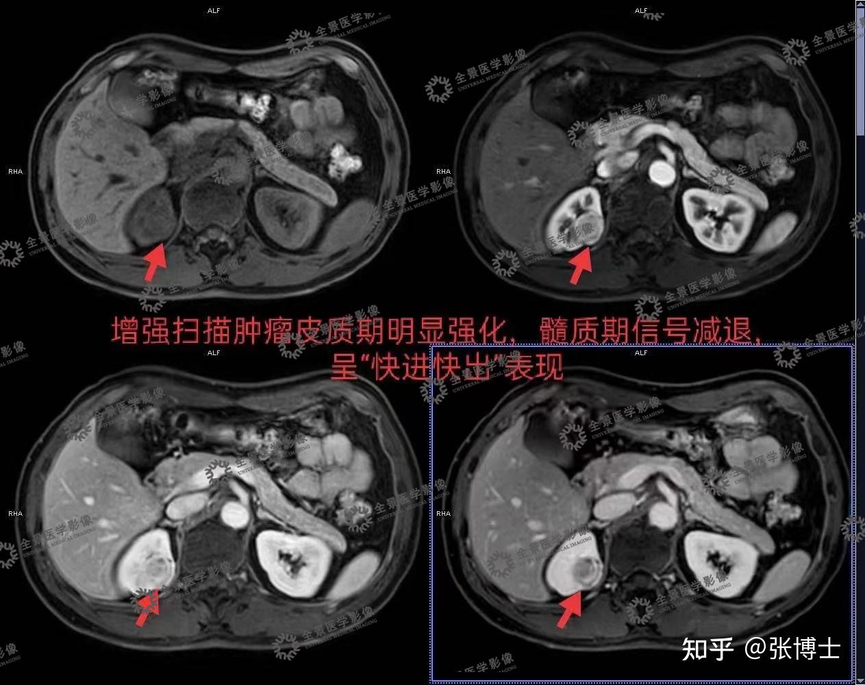 核磁共振检查肾癌