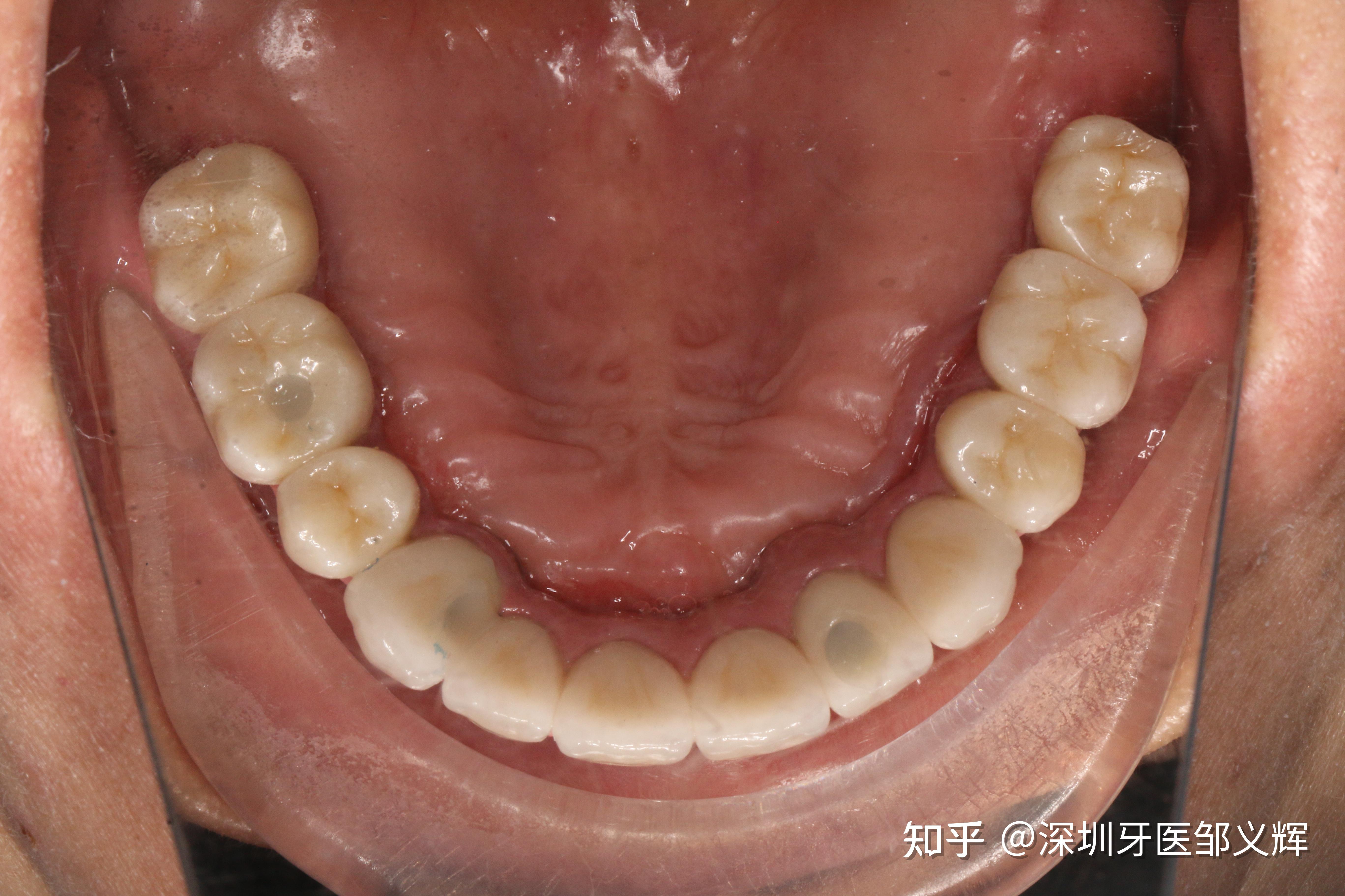 无牙颌修复一例