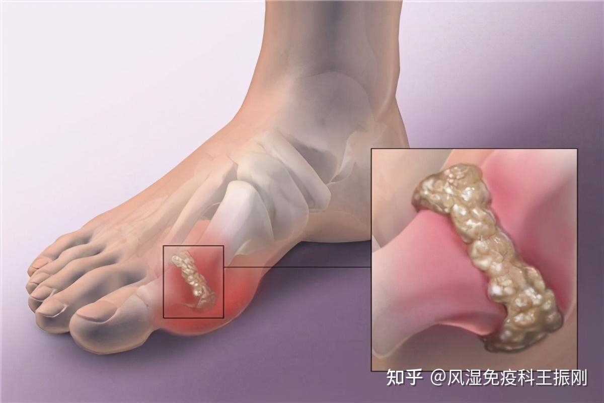 痛风类风湿关节炎骨关节炎的关节畸形还可以恢复吗