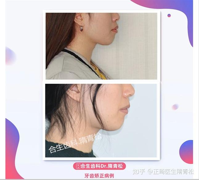 嘴凸是该整牙,还是整下巴? - 知乎