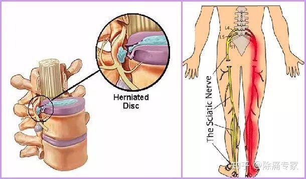 緋聞2:腰疼就是腰椎間盤突出症,腿疼就是骨關節炎