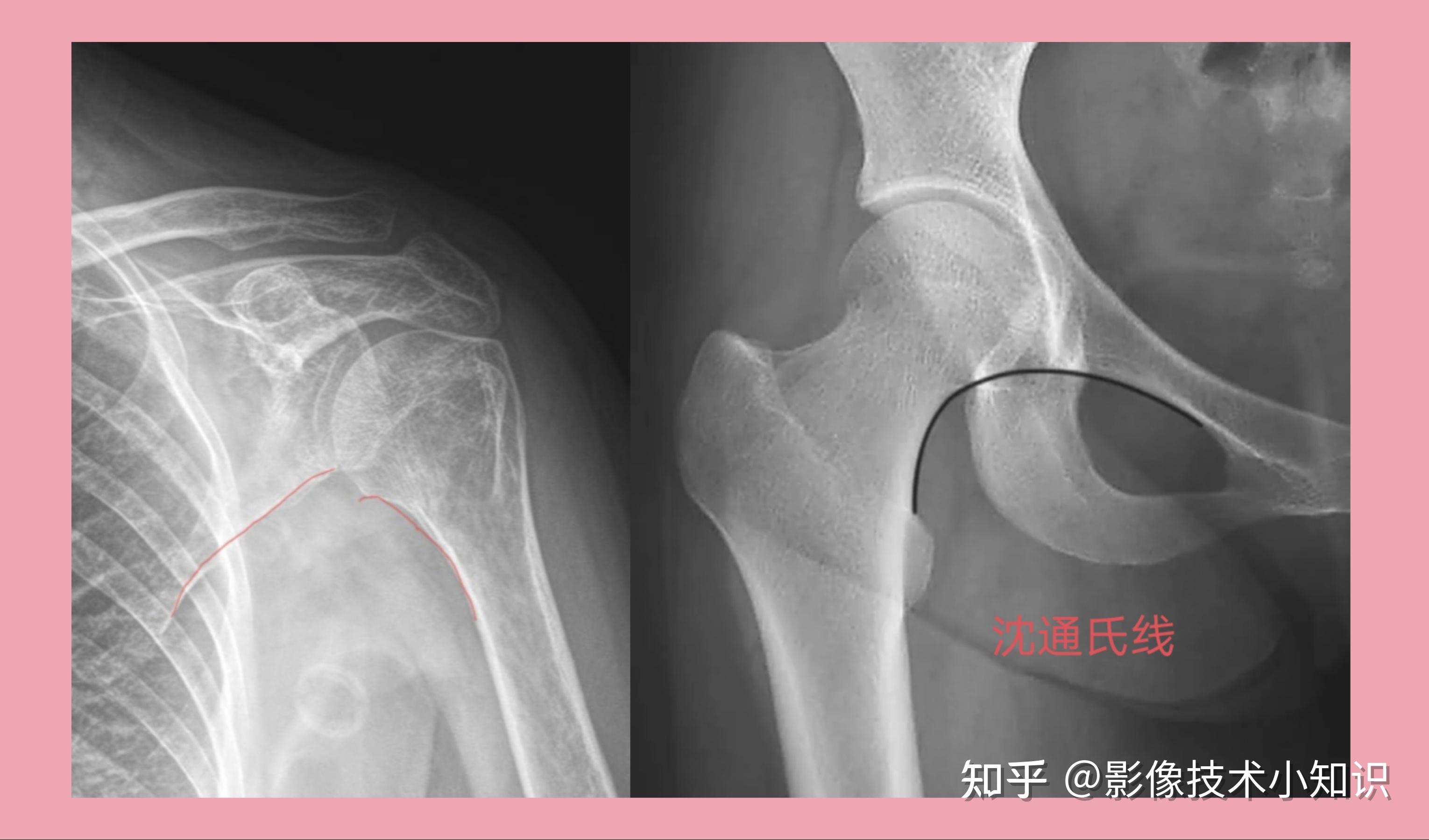 我们先说一下肩关节沈通氏线. 下图:为什么是正常的呢?