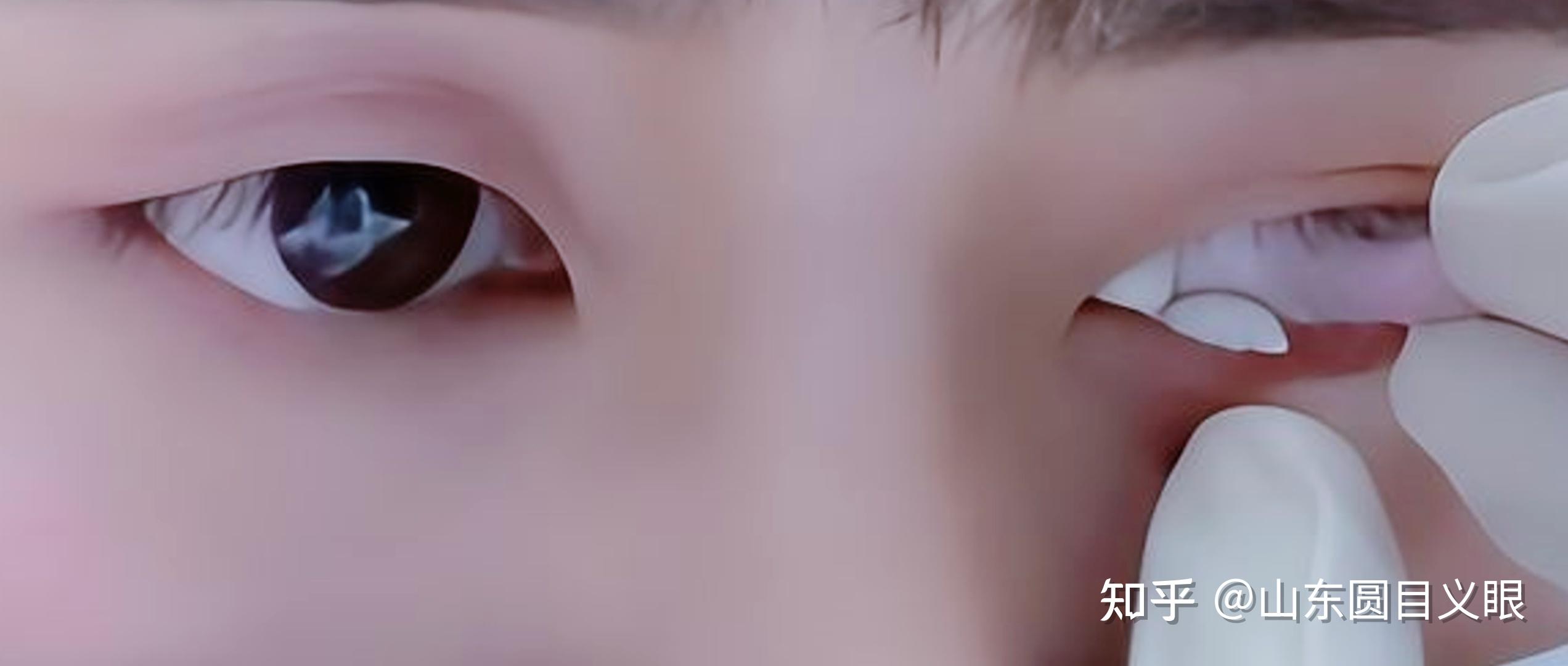 定制义眼是怎么取模? - 知乎
