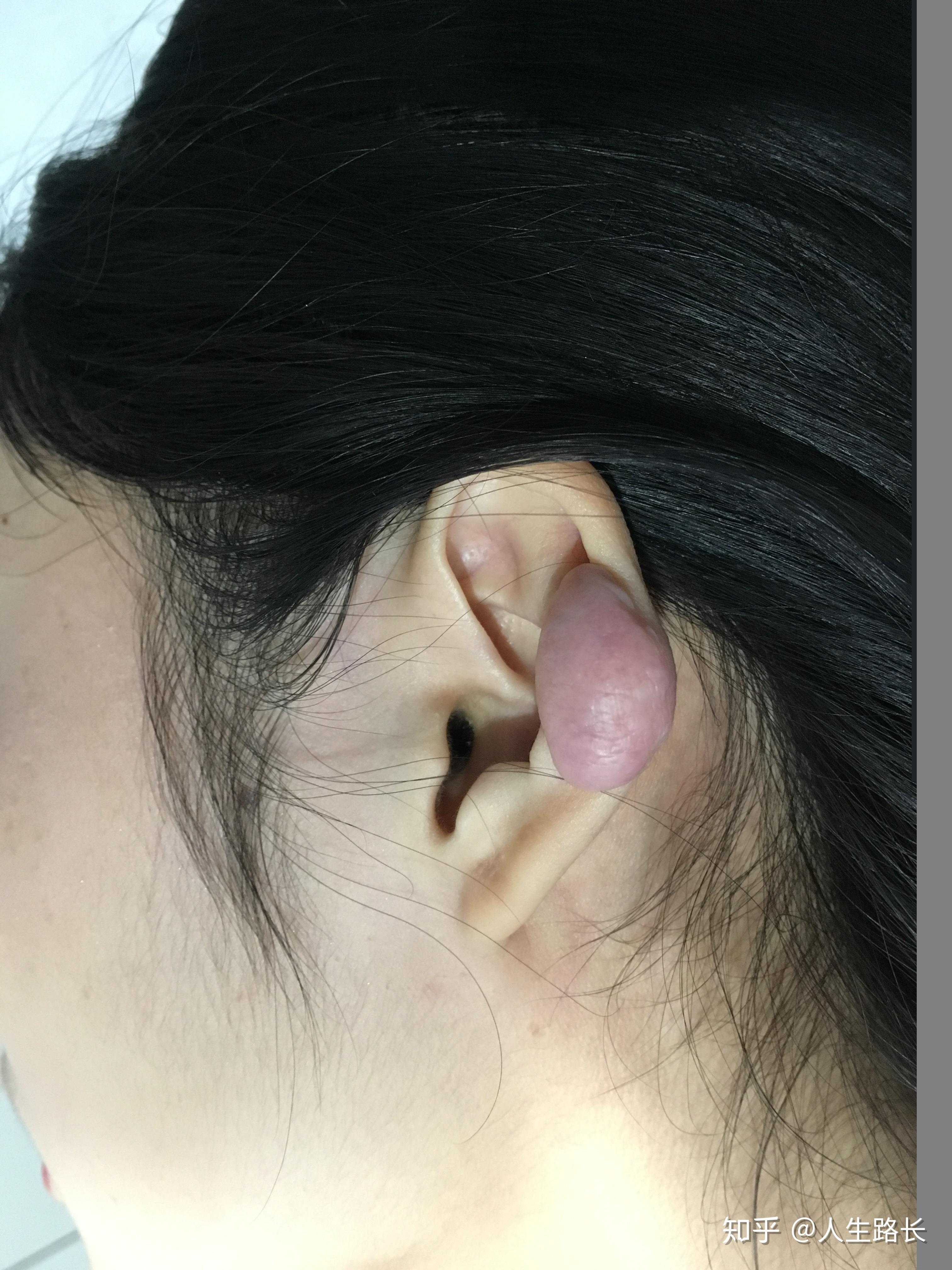 耳部疙瘩切除后多久就不易复发?